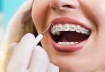 Braces vs Invisible Braces – What is the Difference?